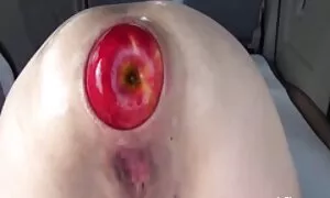 anal fïstïng ëxtrëmë ...